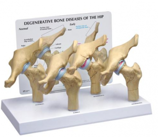 4-stupňové degeneratívne kostné choroby   modelu bedrového kĺbu (Anatomické modely)