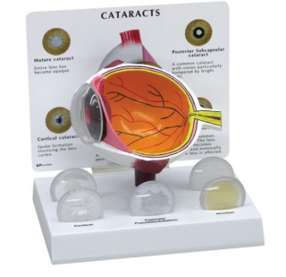 Kataraktové oko (Anatomické modely)
