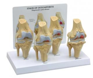 Kolenný kĺb, 4 stupne osteoartrózy (Anatomické modely)