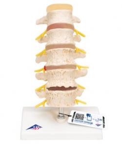 Model bedrovej chrbtice s degenerovanými stavcami a medzistavcovými platničkami (Anatomické modely)