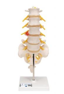 Model bedrovej chrbtice s dorzolaterálnou vyskočenou medzistavcovou platničkou (Anatomické modely)