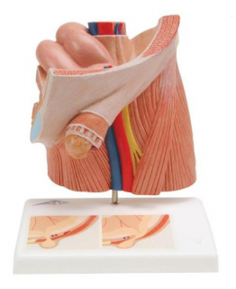 Model inguinálnej hernie (Anatomické modely)
