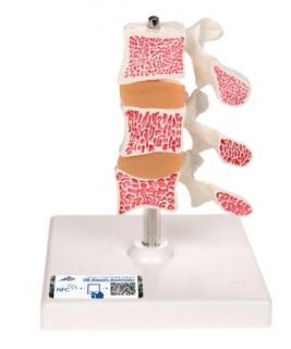 Model ľudských bedrových stavcov s osteoporózou  (Anatomické modely)