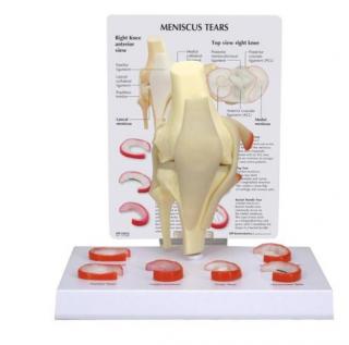 Model menisku kolena s 6 natrhnutími (Anatomické modely)