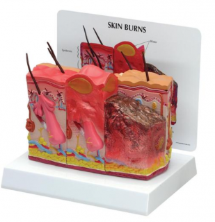 Model popálenej kože (Anatomické modely)