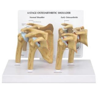 Model ramena, 4 stupne osteoartrózy (Anatomické modely)