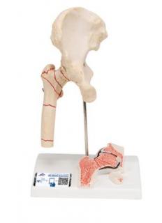 Model zlomeniny ľudskej stehennej kosti a osteoartrózy bedrového kĺbu (Anatomické modely)