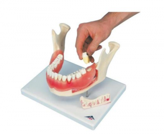 Zubné ochorenie, zväčšené 2 krát, 21 častí (Anatomické modely)